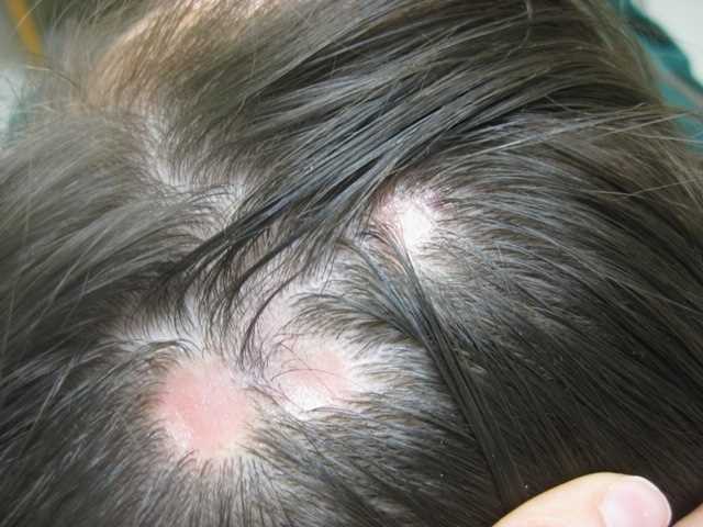 Understanding Hair Loss And Its Remedies And Treatments